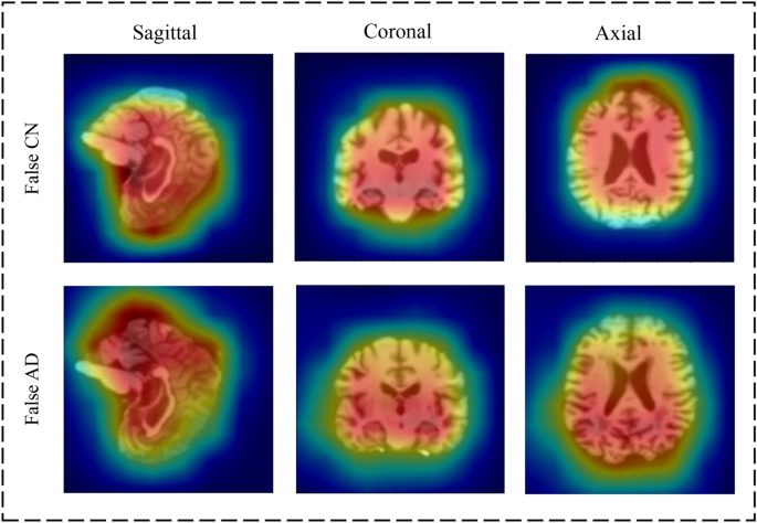 Convolutional Spatio-Temporal Attention for Alzheimer’s Disease Classification Using Brain MRI