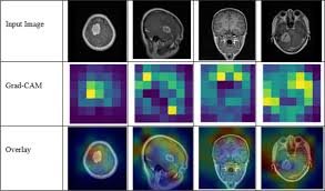 Enhanced Classification of Brain Tumors from MRI Scans using a Hybrid CNN-Transformer ModelData Engineering